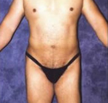 Male Body Contouring Before & After