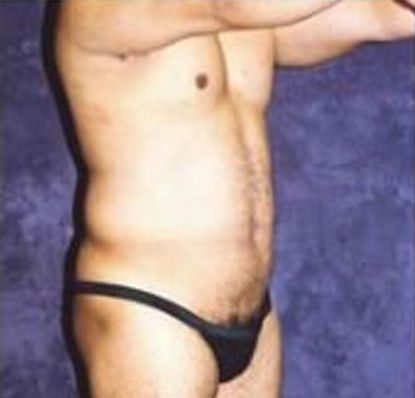 Male Body Contouring Before & After