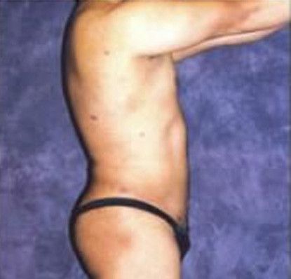 Male Body Contouring Before & After