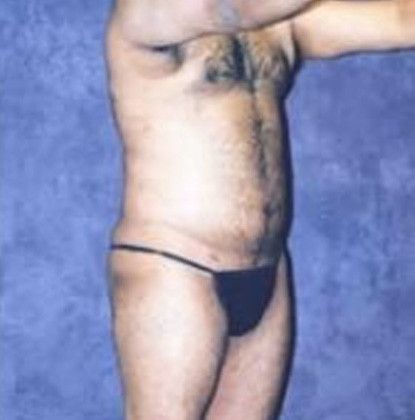 Male Body Contouring Before & After