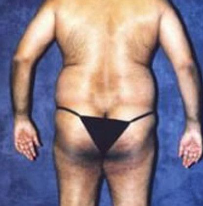 Male Body Contouring Before & After