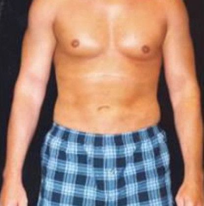 Male Body Contouring Before & After
