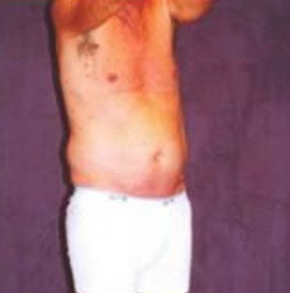 Male Body Contouring Before & After