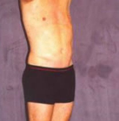 Male Body Contouring Before & After