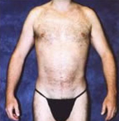 Male Body Contouring Before & After