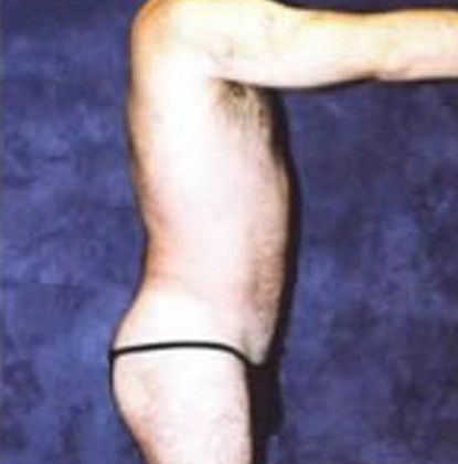 Male Body Contouring Before & After