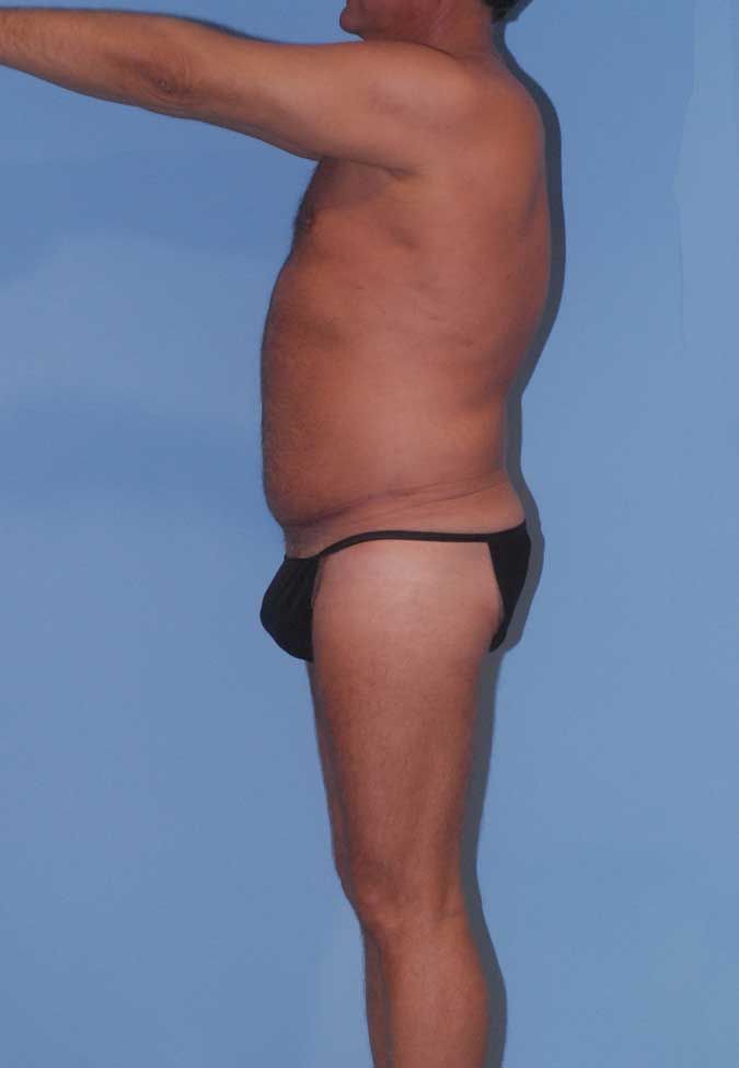 Male Body Contouring Before & After