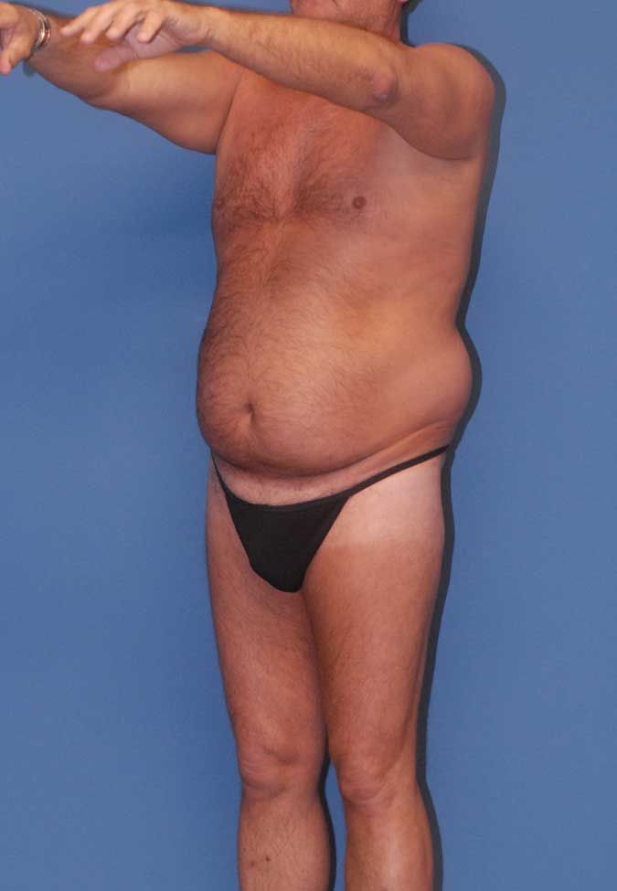 Male Body Contouring Before & After