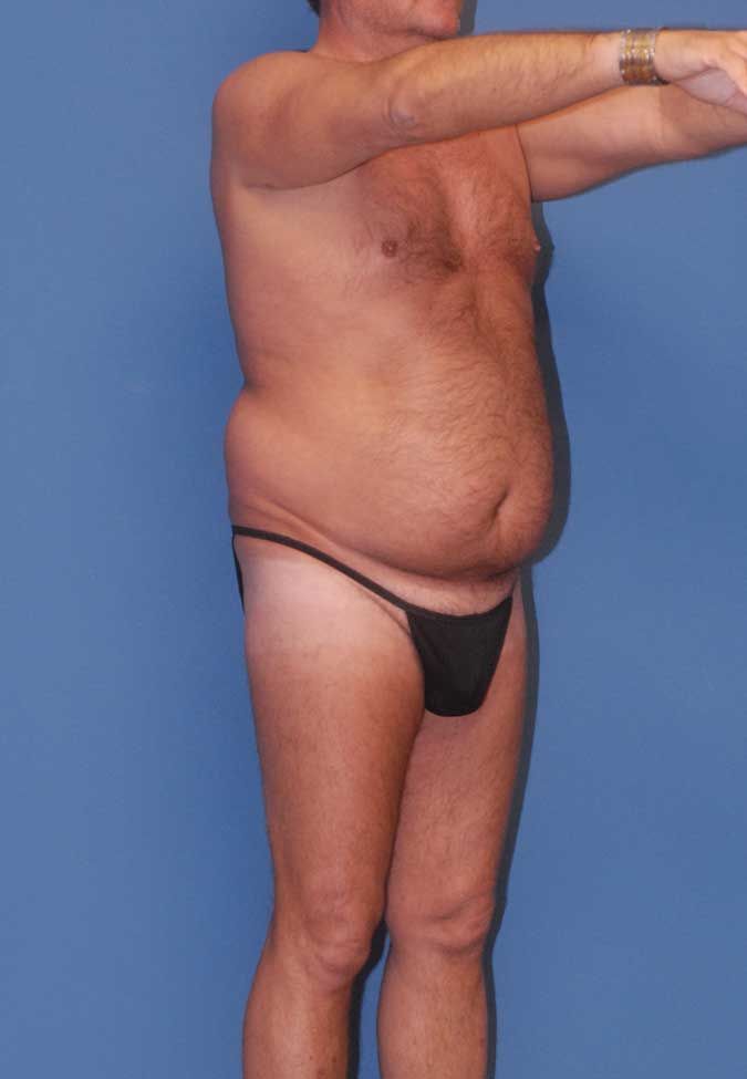 Male Body Contouring Before & After