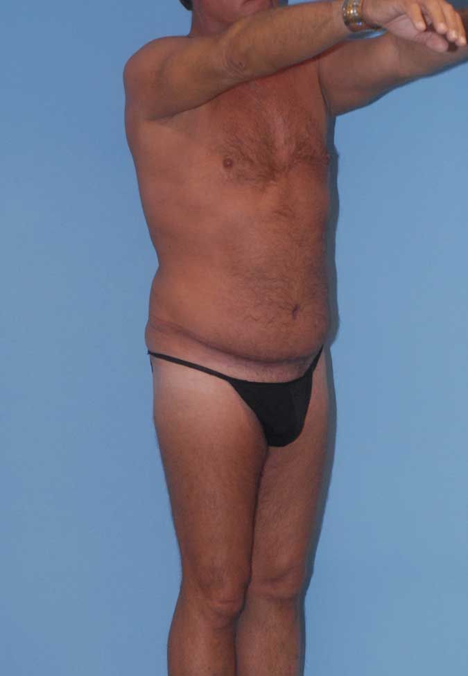 Male Body Contouring Before & After