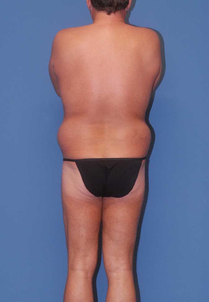 Male Body Contouring Before & After