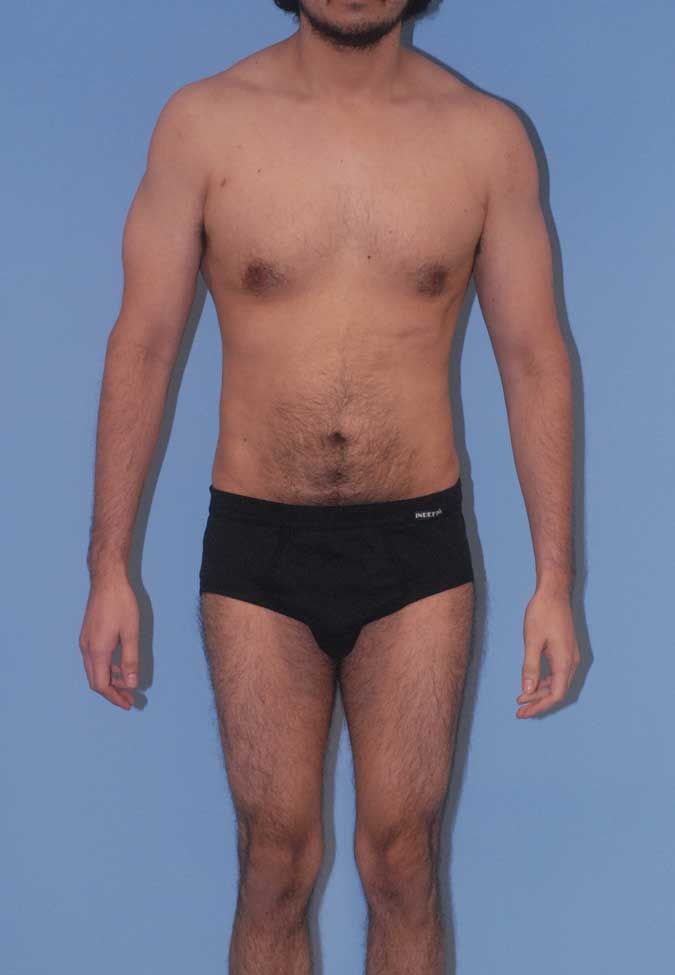 Male Body Contouring Before & After