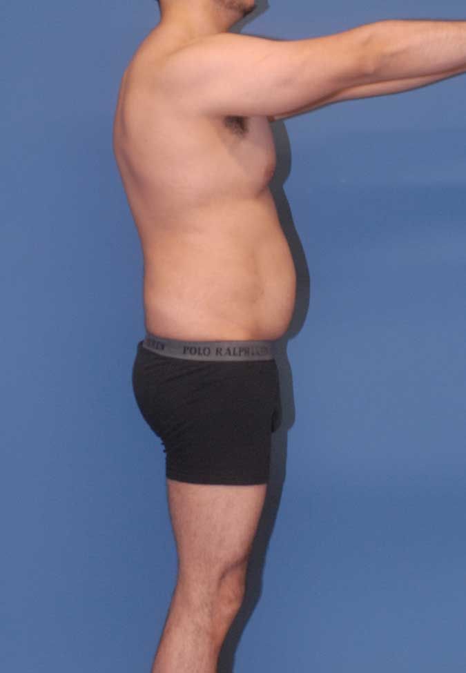 Male Body Contouring Before & After