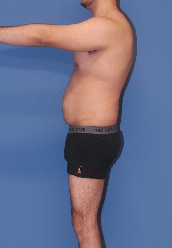 Male Body Contouring Before & After