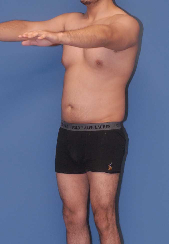 Male Body Contouring Before & After