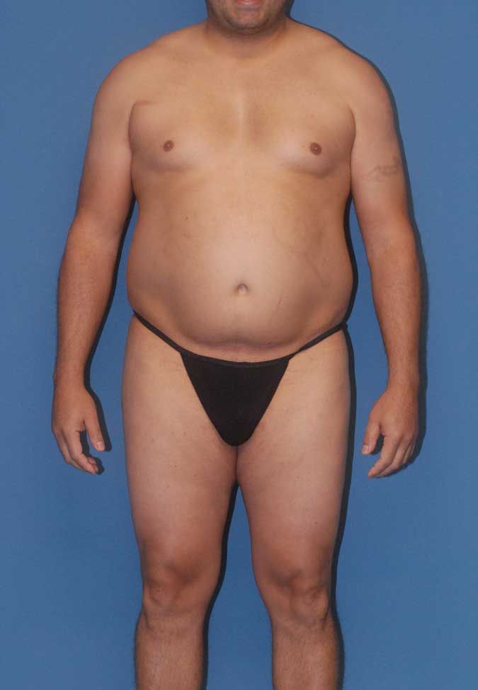 Male Body Contouring Before & After