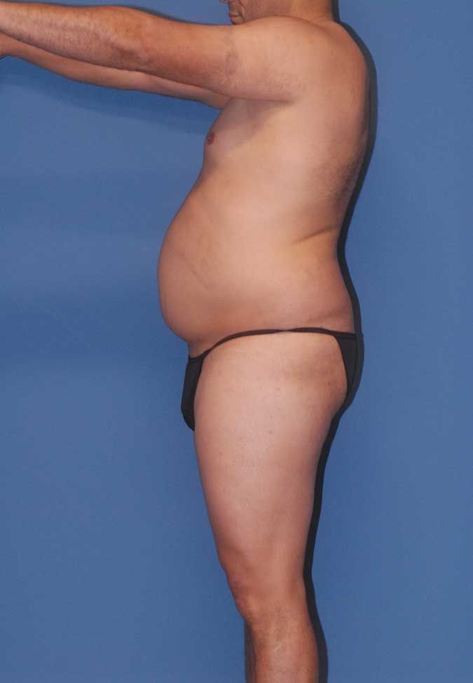 Male Body Contouring Before & After