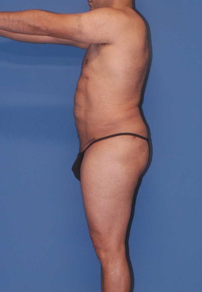 Male Body Contouring Before & After