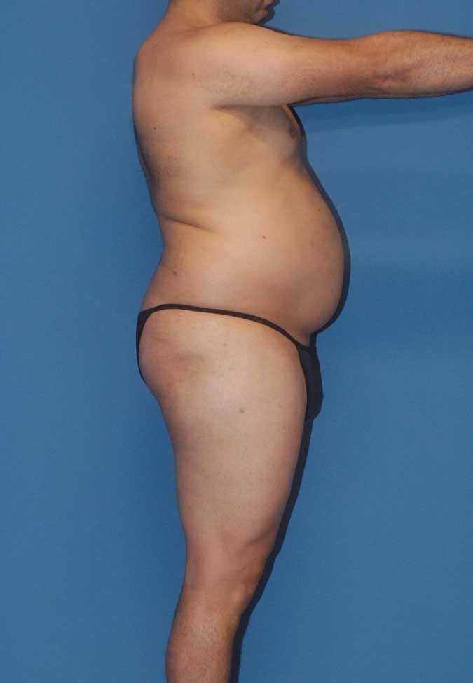 Male Body Contouring Before & After