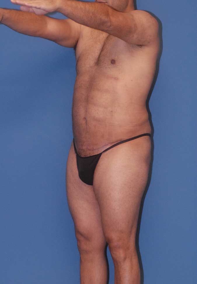 Male Body Contouring Before & After