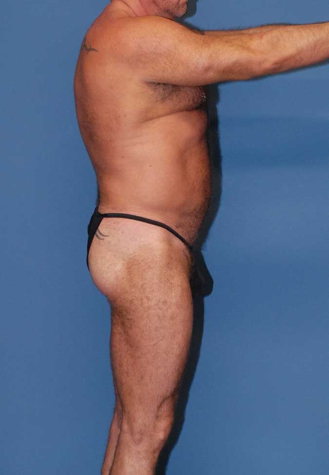 Male Body Contouring Before & After