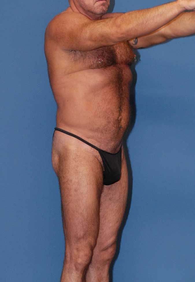 Male Body Contouring Before & After