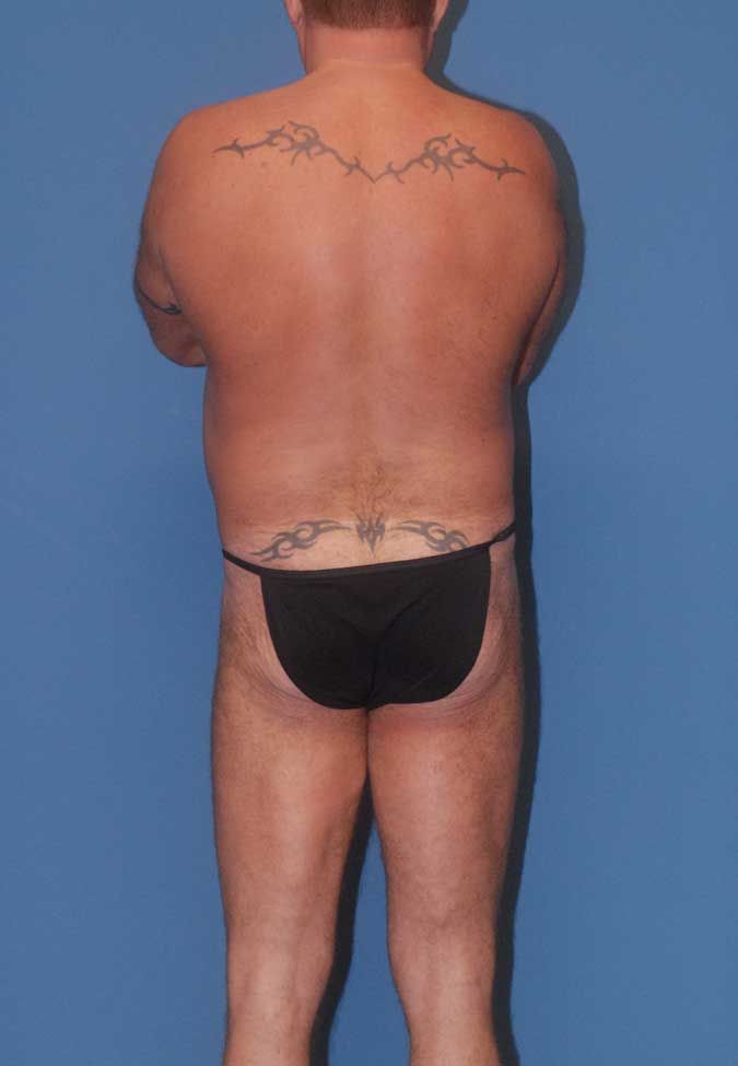 Male Body Contouring Before & After