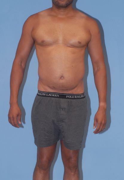 Male Body Contouring Before & After