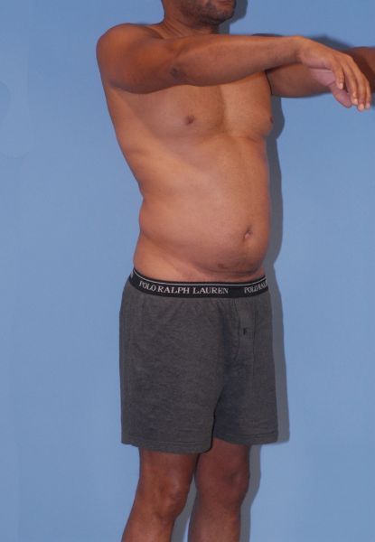 Male Body Contouring Before & After