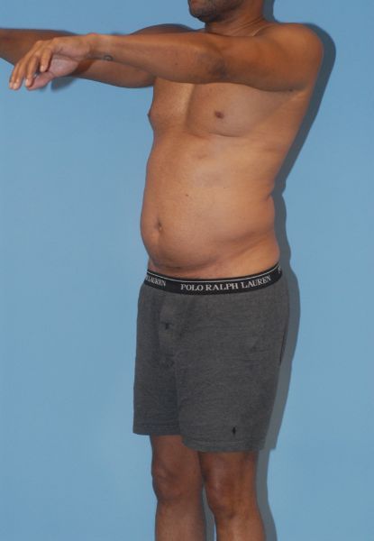 Male Body Contouring Before & After