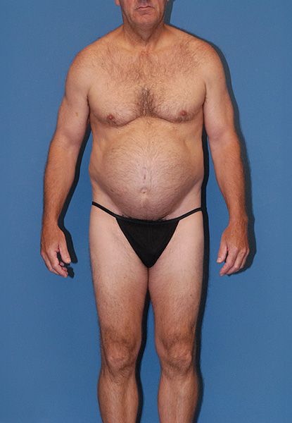 Male Body Contouring Before & After