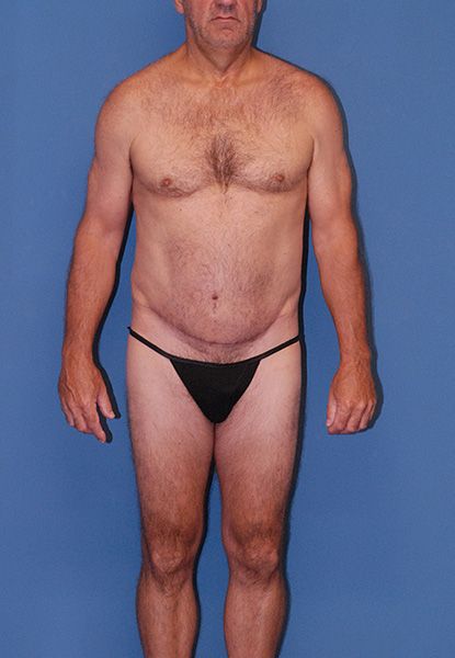 Male Body Contouring Before & After