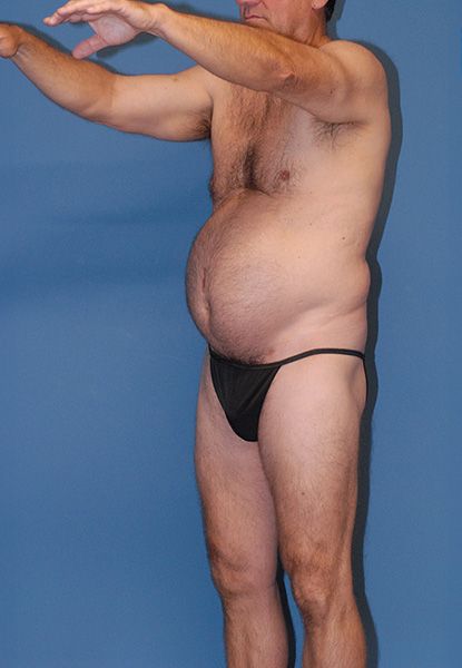 Male Body Contouring Before & After