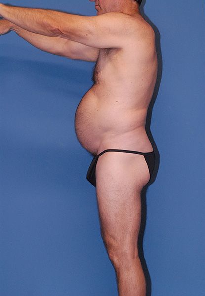 Male Body Contouring Before & After