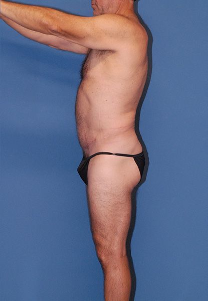 Male Body Contouring Before & After