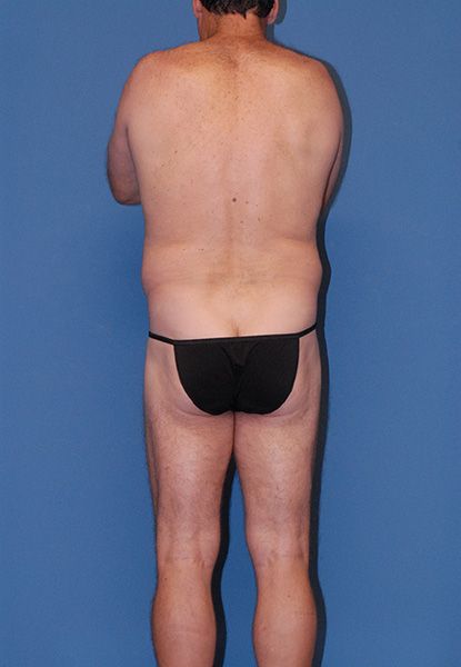 Male Body Contouring Before & After