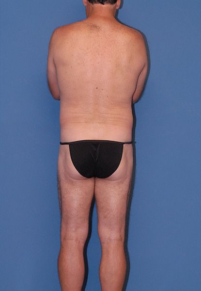 Male Body Contouring Before & After