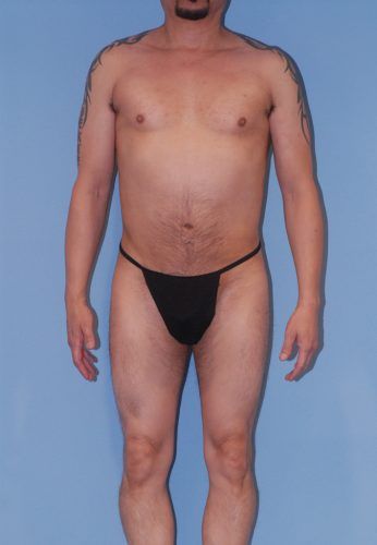 Male Body Contouring Before & After