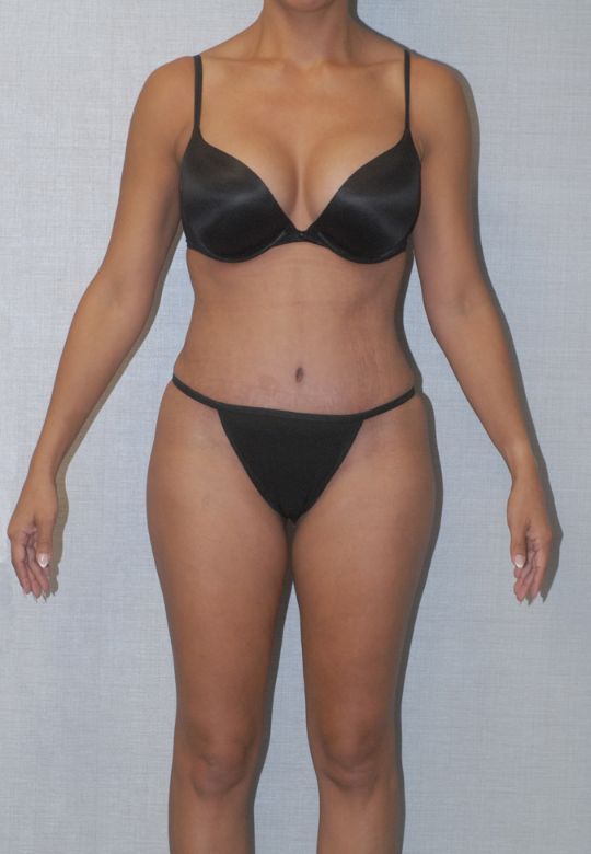 Mommy Makeover Before & After