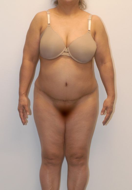 Mommy Makeover Before & After