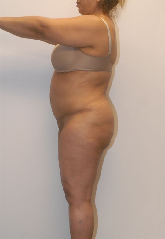 Mommy Makeover Before & After