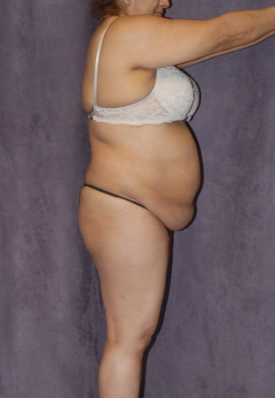 Mommy Makeover Before & After