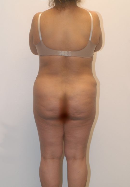 Mommy Makeover Before & After