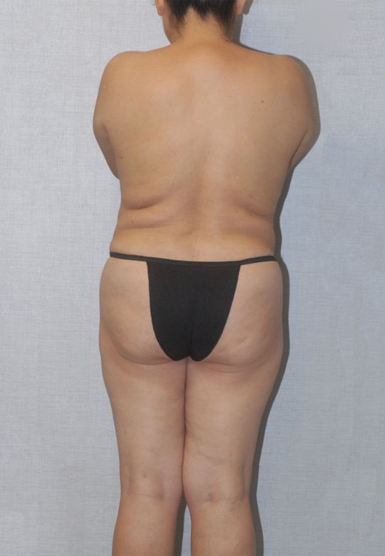 Mommy Makeover Before & After