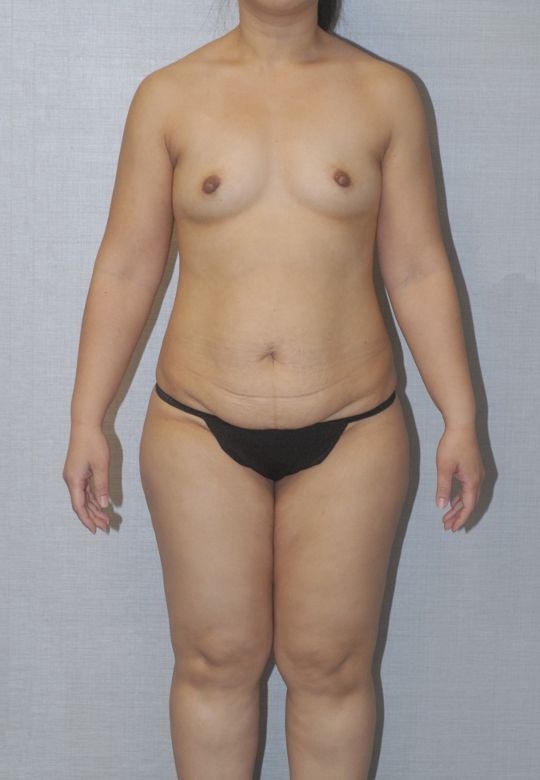 Mommy Makeover Before & After