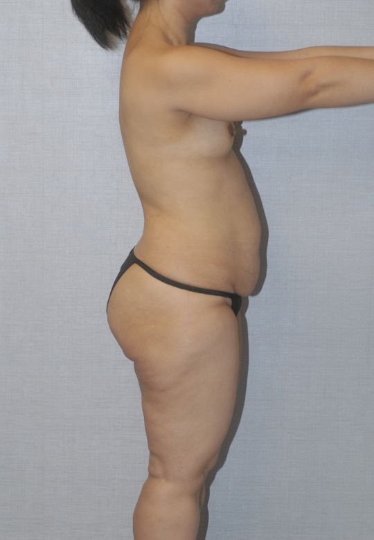 Mommy Makeover Before & After