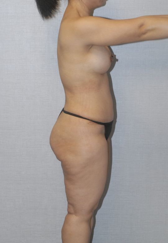 Mommy Makeover Before & After