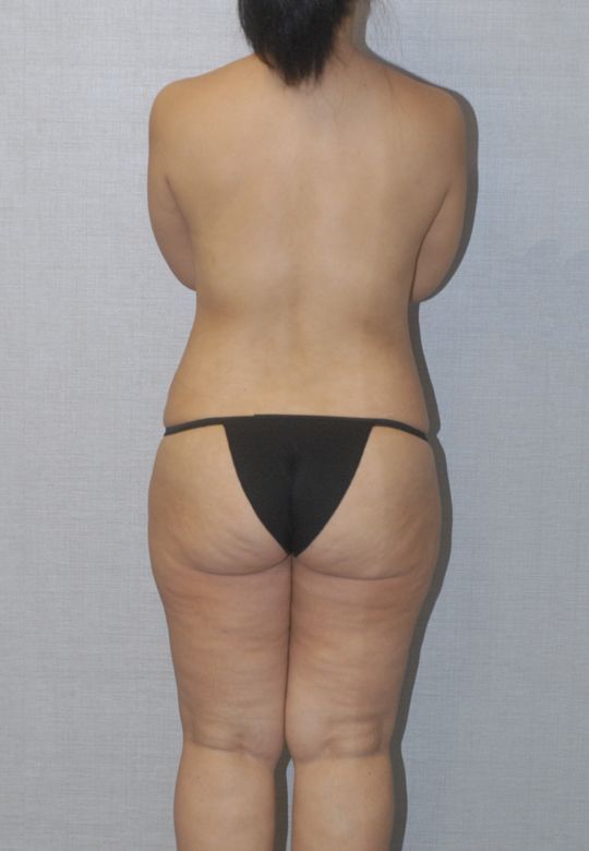 Mommy Makeover Before & After