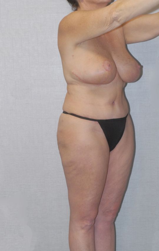 Mommy Makeover Before & After