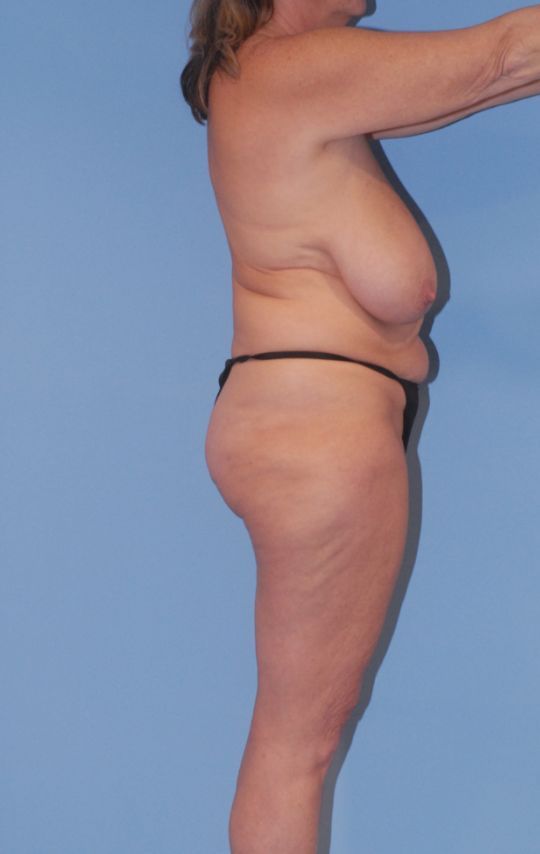 Mommy Makeover Before & After